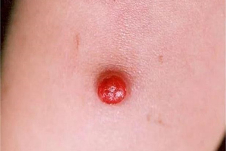 巴尔通体病胳膊结节图