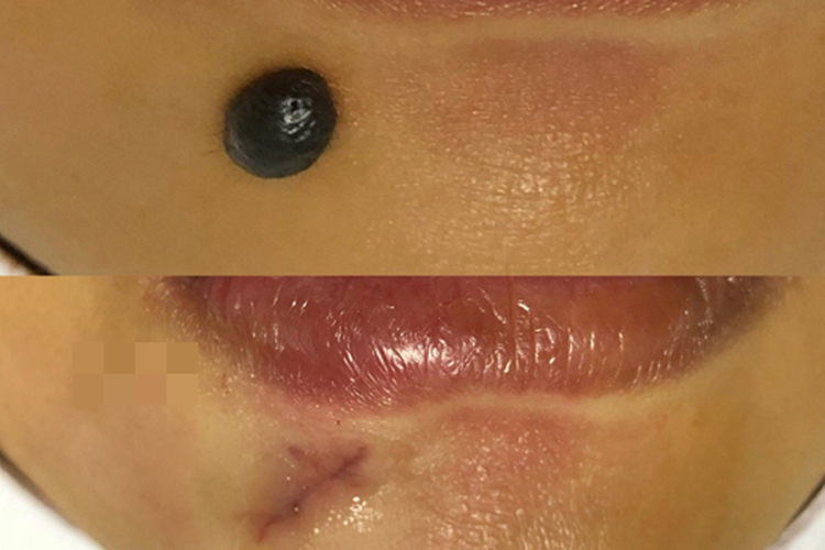 色素痣切除后效果图