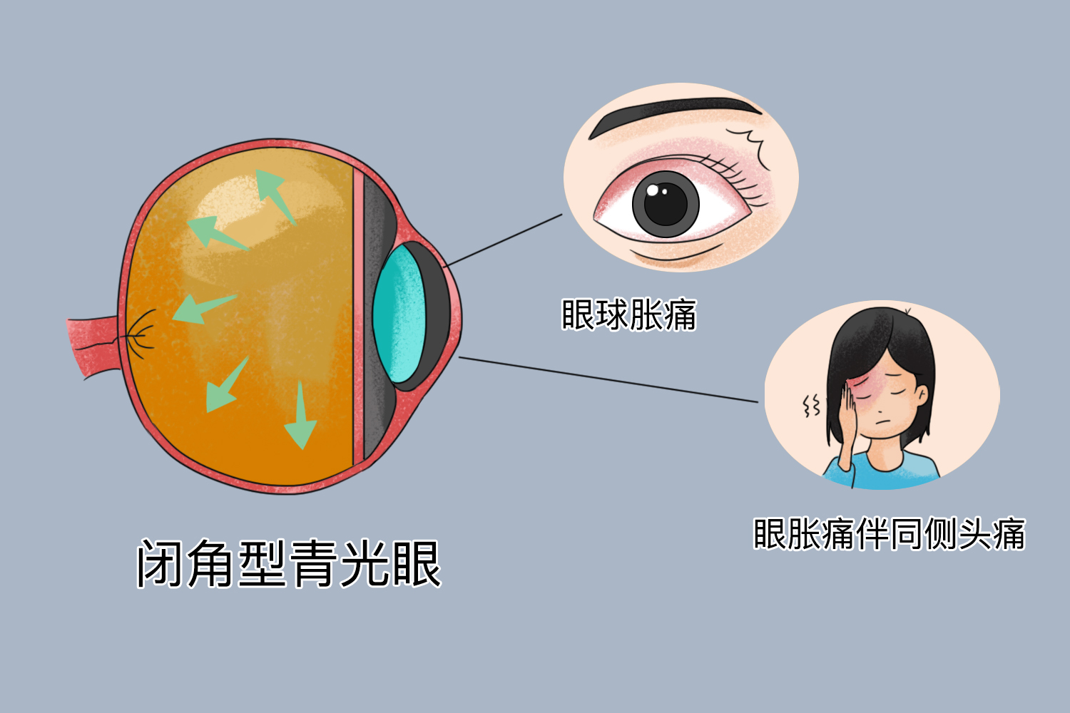 闭角型青光眼图