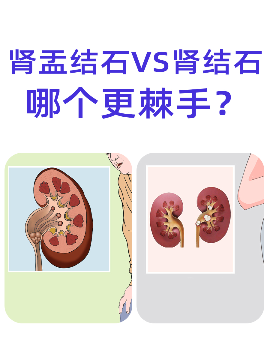 肾盂结石VS肾结石,哪个更棘手?