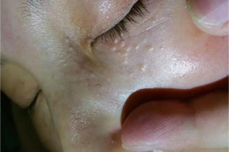 汗腺瘤眼周白色小疙瘩图