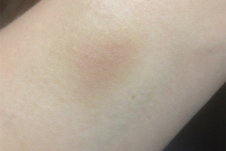 黄色淤青图 黄色淤青图