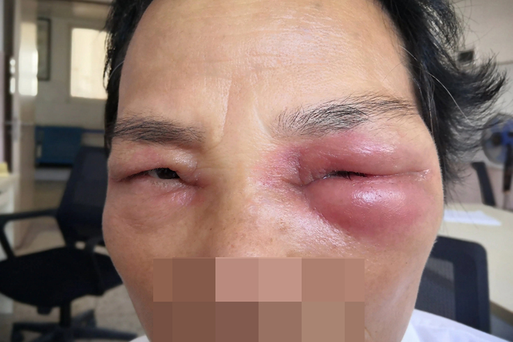 眼睑蜂窝织炎图