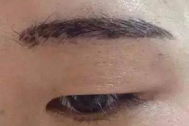 纹眉结痂太厚图