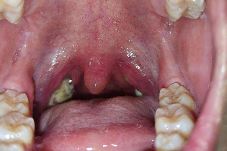 嗓子发炎化脓图