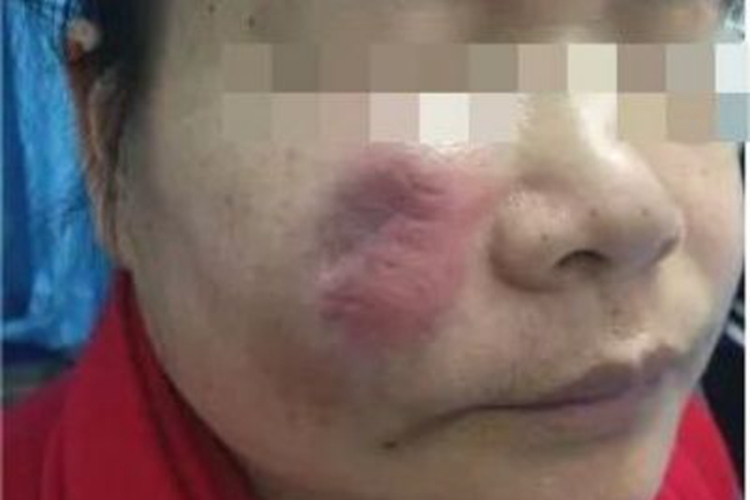 女性深在性红斑狼疮图