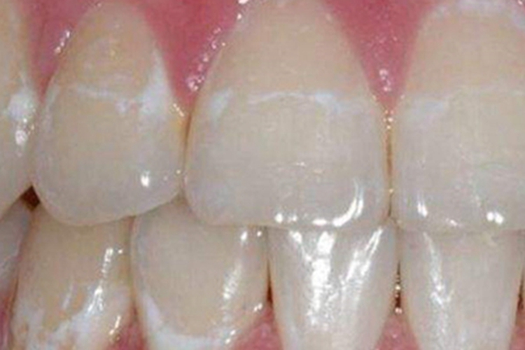浅龋牙齿平滑面症状图