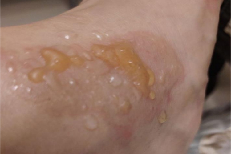 二度烫伤脚踝症状图 二度烫伤脚踝症状图