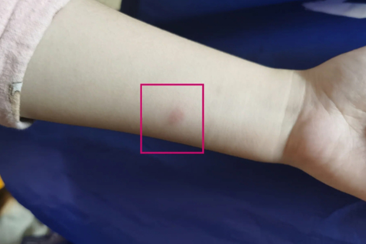 PPD皮试阳性有硬结图