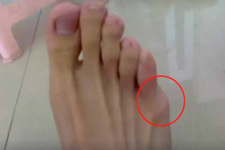 第五跖骨骨折脚肿胀图 第五跖骨骨折脚肿胀图