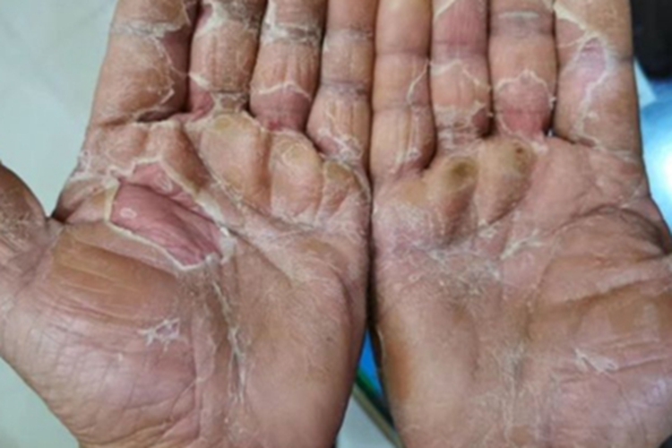 剥脱性角质松解症手掌症状图
