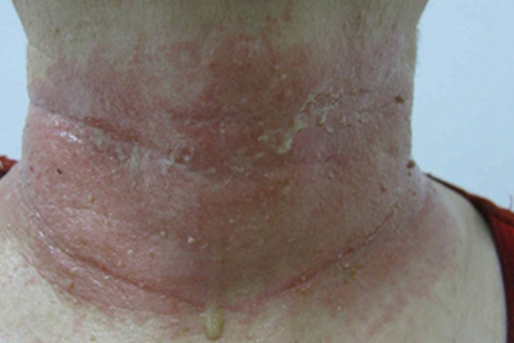 皮肤过敏红肿化脓图