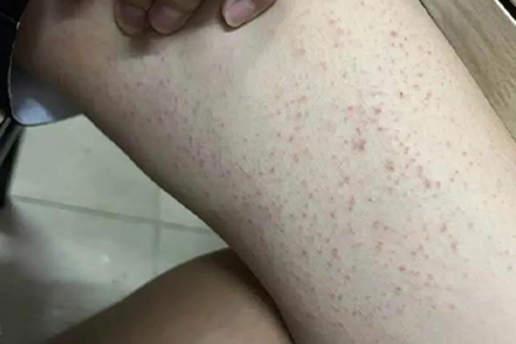 大腿内侧毛囊炎图