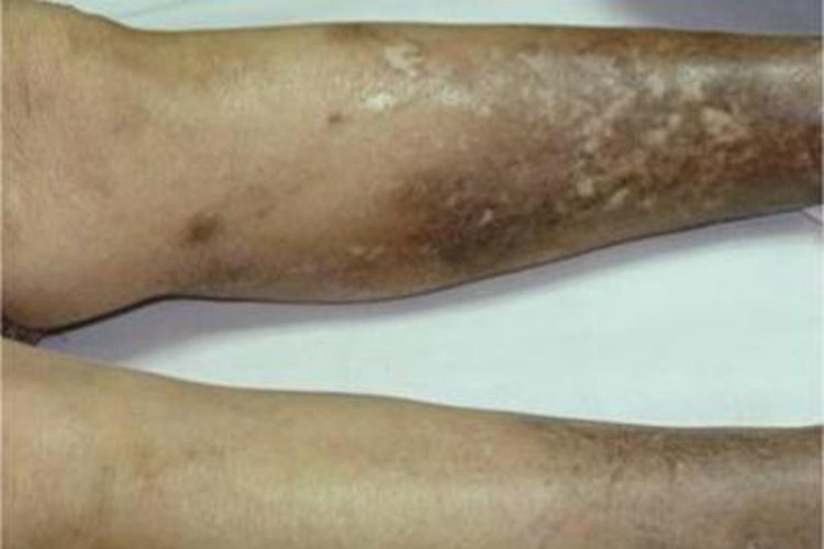 慢性放射性皮炎小腿皮肤粗糙图