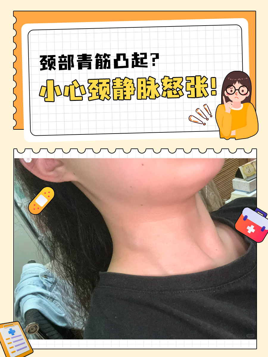 颈部青筋凸起？小心颈静脉怒张！