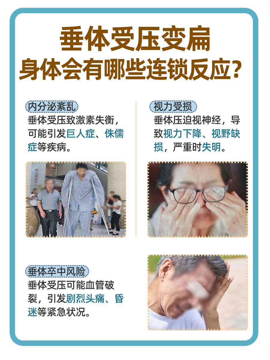 垂体变扁,这些健康隐患你中招了吗?