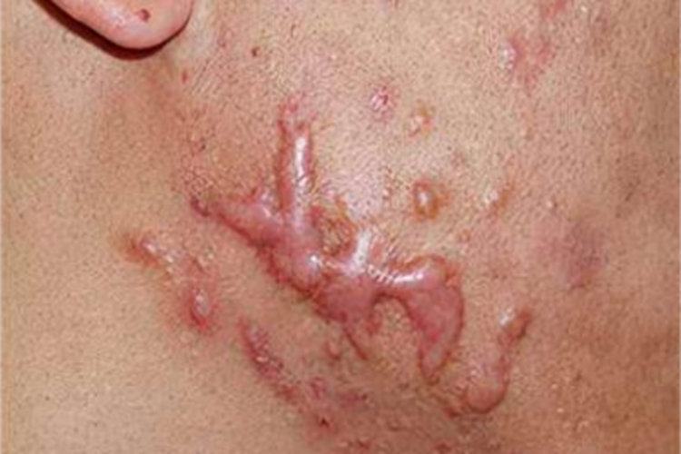 瘢痕疙瘩性芽生菌病面部瘢痕图