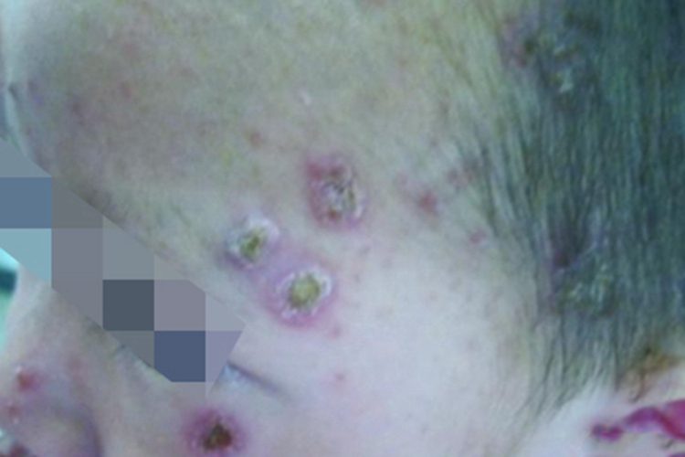 慢性黏膜皮肤念珠菌病面部结节图