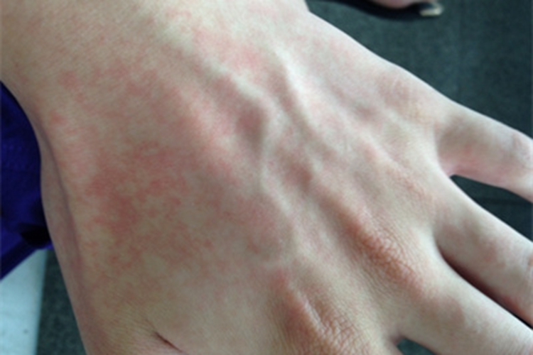 色素性紫癜性皮病手背红斑图