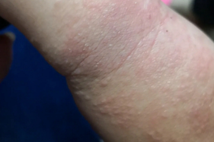 奶癣胳膊小疙瘩图