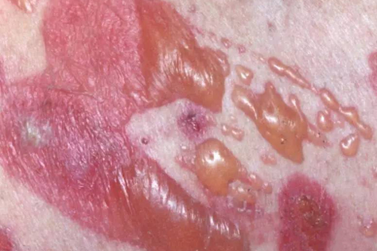 二期梅毒水疱图