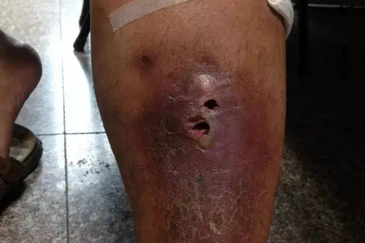 骨结核脓肿窦道图 骨结核脓肿窦道图