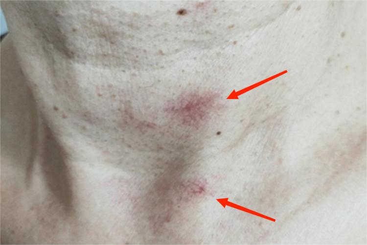 蜘蛛痣脖子有红血丝图 蜘蛛痣脖子有红血丝图