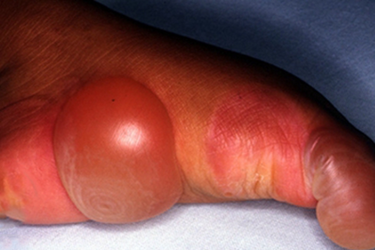 交界型大疱性表皮松解症大水疱图