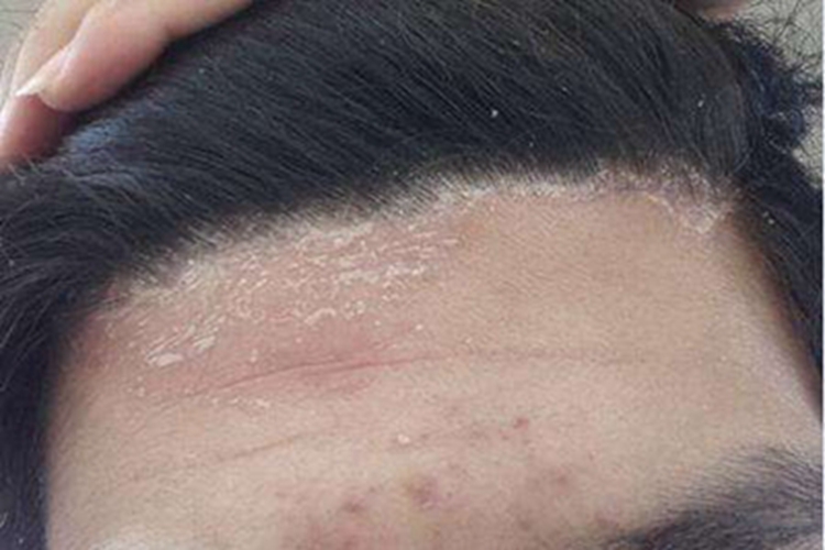 特应性皮炎前额脱屑图