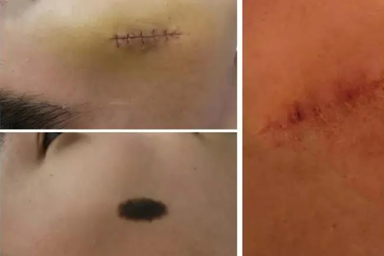 黑痣切除后恢复过程图