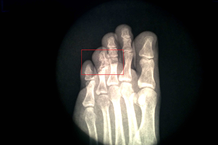 近节趾骨骨折图