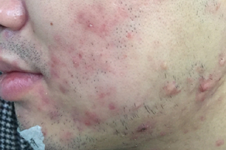 结节性类天疱疮面部症状图