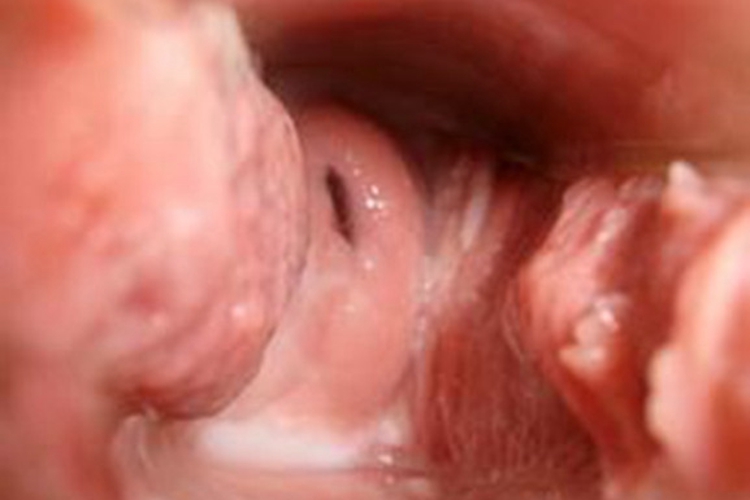 外阴阴道假丝酵母菌病阴道充血红肿图