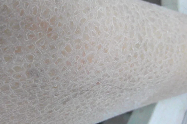 毛囊性鱼鳞病小腿脱屑图 毛囊性鱼鳞病小腿脱屑图