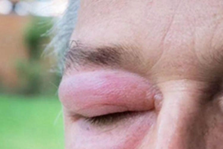 旋毛虫病眼睑红肿图