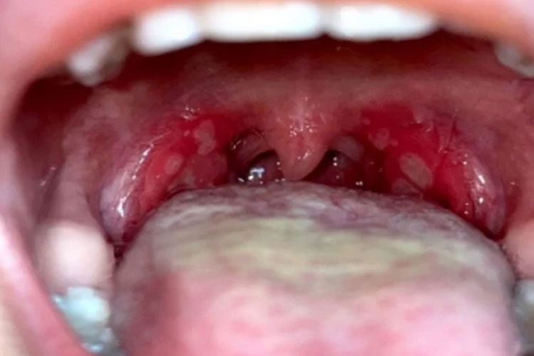 小孩疱疹性咽峡炎图