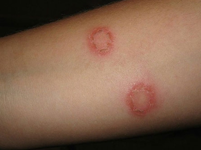 体癣患者胳膊上可出现两个硬币大小的红色圆圈,隆起于皮肤表面,其内侧
