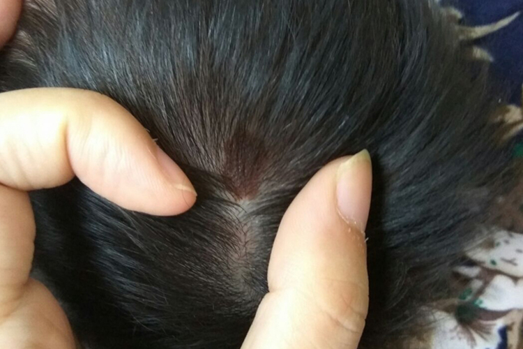 宝宝头皮咖啡斑图