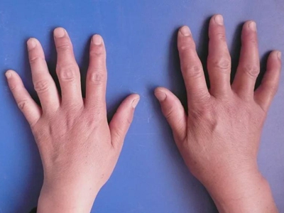 手指类风湿性关节炎手指肿胀图