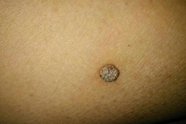 寻常疣大腿内侧凸起肉粒图 寻常疣大腿内侧凸起肉粒图