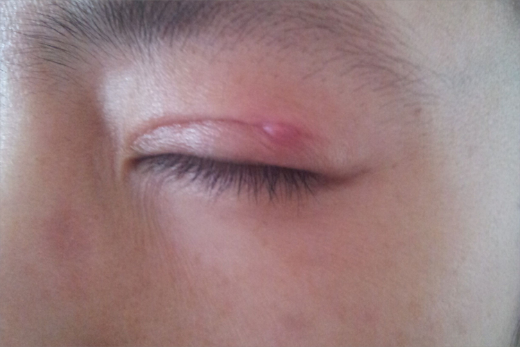 皮肤纤维瘤眼睑小红疙瘩图