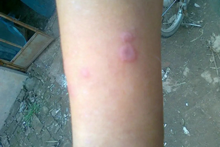 结节性脂膜炎胳膊红斑图 结节性脂膜炎胳膊红斑图