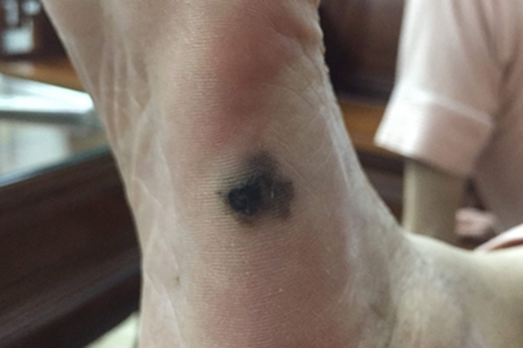 恶性雀斑痣样黑素瘤脚部症状图