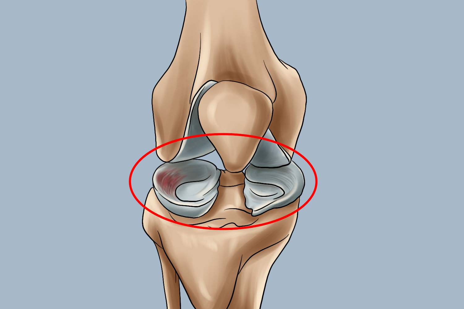 半月板后角撕裂疼痛位置图