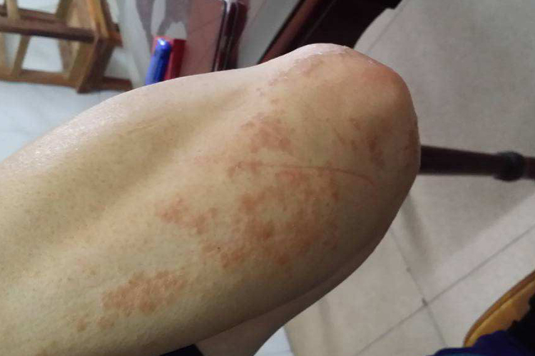 胳膊肘荨麻疹图