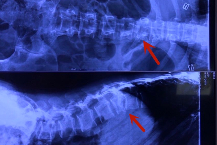 胸椎爆裂性骨折影像图