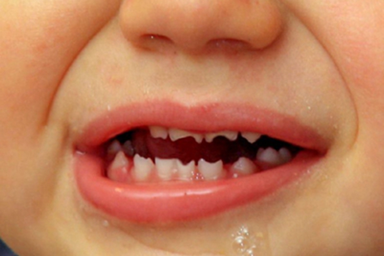 先天性梅毒牙齿缺损图 先天性梅毒牙齿缺损图