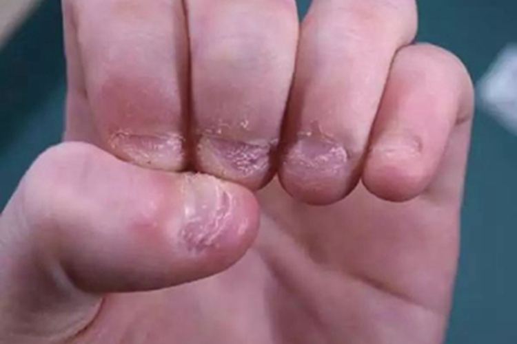 咬甲癖手指甲缺损图