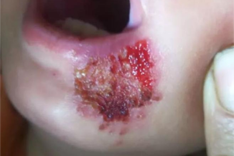 脓疱病口周症状图 脓疱病口周症状图