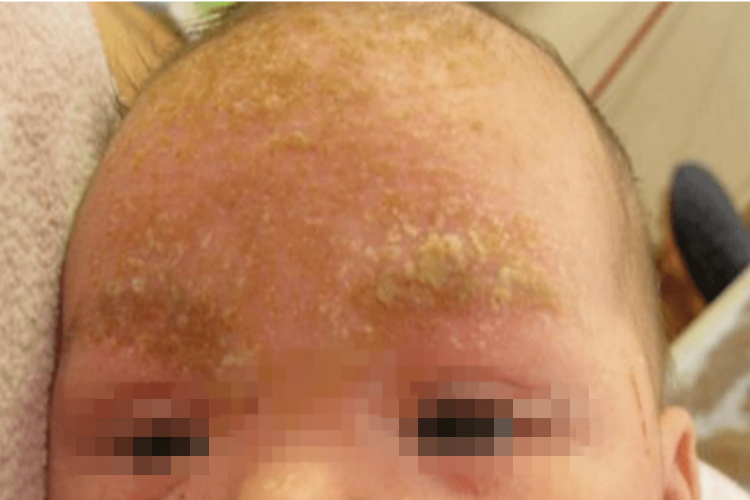 奶癣额头上有一块块的黄痂图 奶癣额头上有一块块的黄痂图